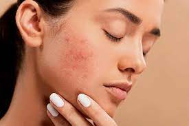 effective acne treatments