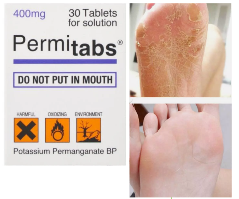 N-Potab Potassium Permanganate 30 BP Solution Tablets are used for weeping, exuding or for blistered skin that requires drying up. It is only used when all other forms of antibacterial agents have been tried.

N-Potab Potassium Permanganate 30 BP Solution Tablets need to be dissolved in water, to make a potassium permanganate solution.

Please note picture for illustative purposes only

Directions:

How To Use:


ALWAYS read the enclosed leaflet for full instructions
This medicine is for external use only.
